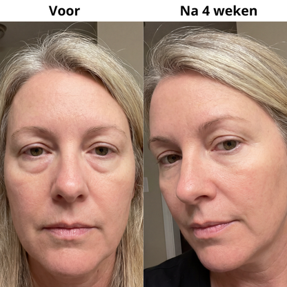Micro-Infusion Patches (Uitverkoop)