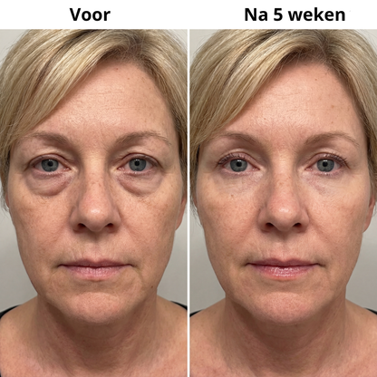 Micro-Infusion Patches (Uitverkoop)